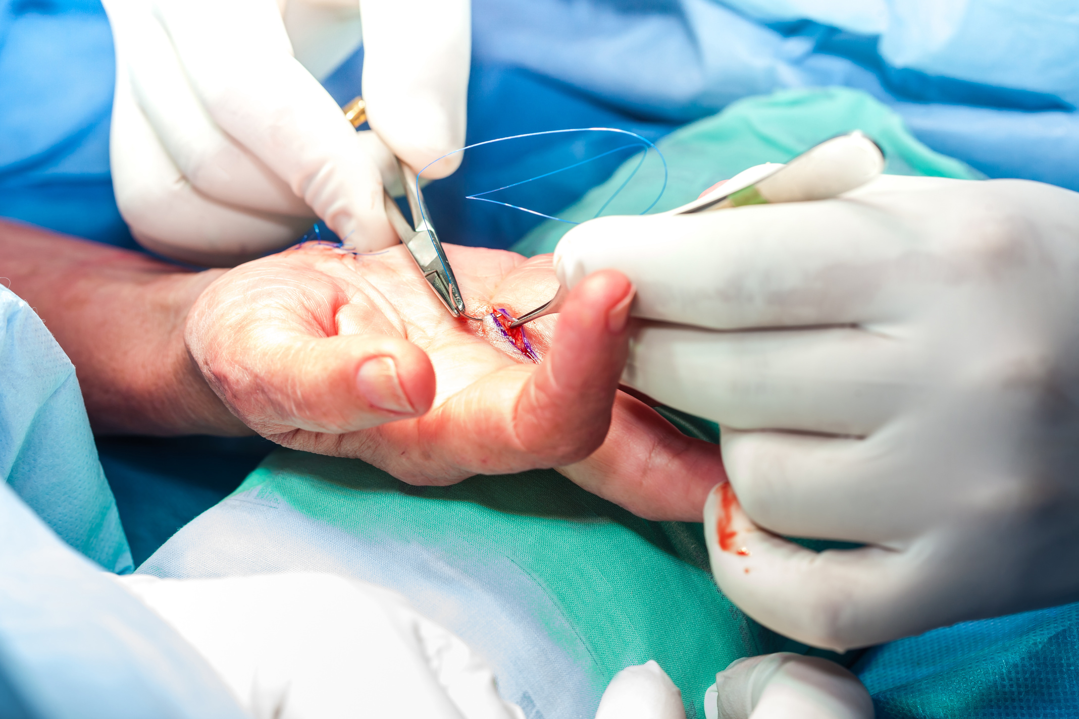 Surgeon suturing the hand of a patient at the end of surgery